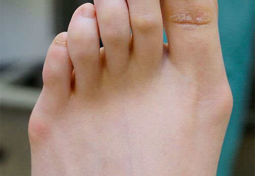 Turning feet out
