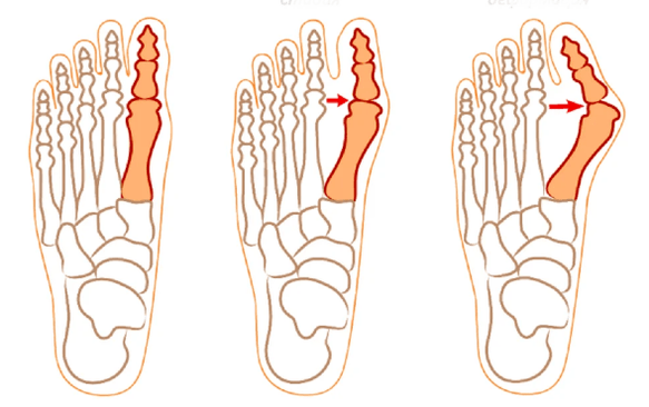 hallux valgus deformity