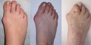 Stages of hallux valgus