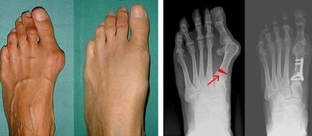Symptoms of bunions