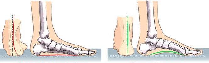 Flat feet and normal feet