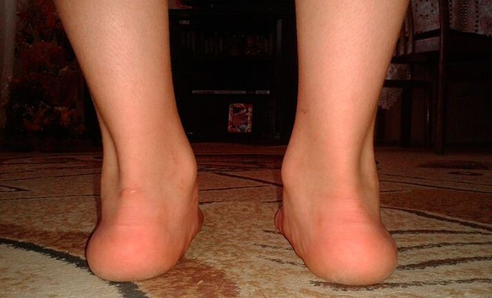 Flat feet eversion