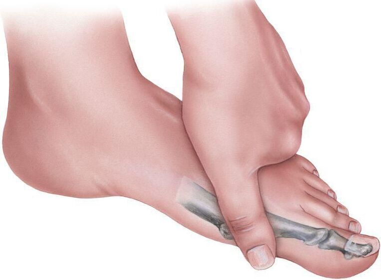 Foot pain with planar valgus deformity