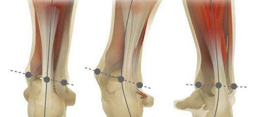 Norm and curvature of foot axis in plane valgus deformity