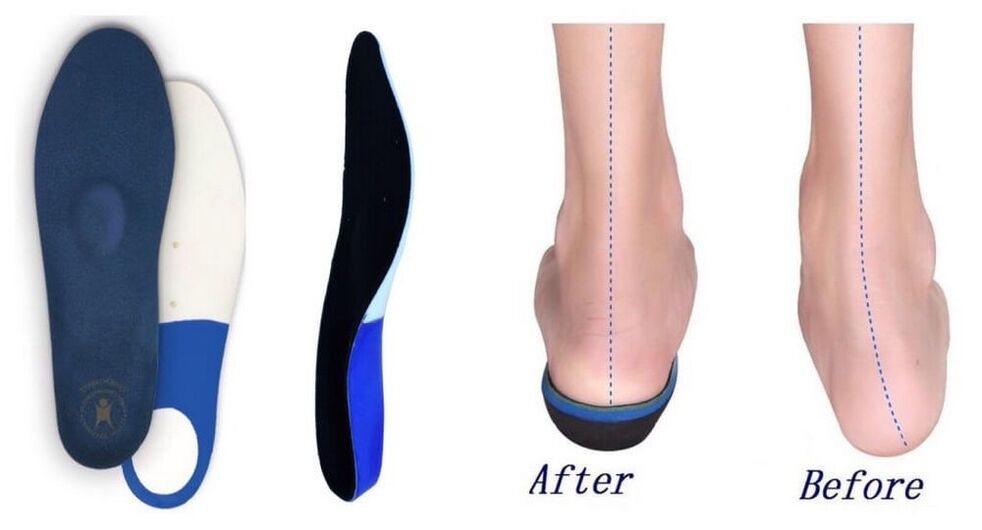 Orthopedic insoles for flatfoot and clubfoot deformities