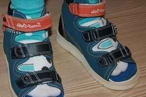 Children with bunion wear sandals