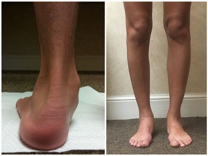 hallux valgus legs