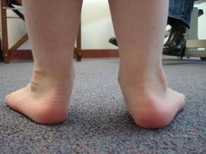Flat foot deformity in children