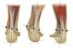 Normal foot with calcaneal valgus and varus deviations