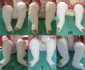 Plastering procedures, each procedure changes the position of the feet
