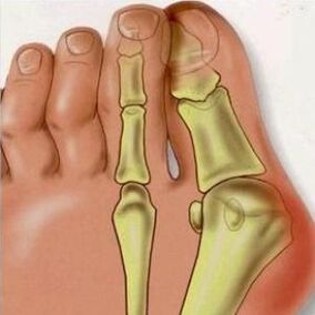 Reasons for transverse