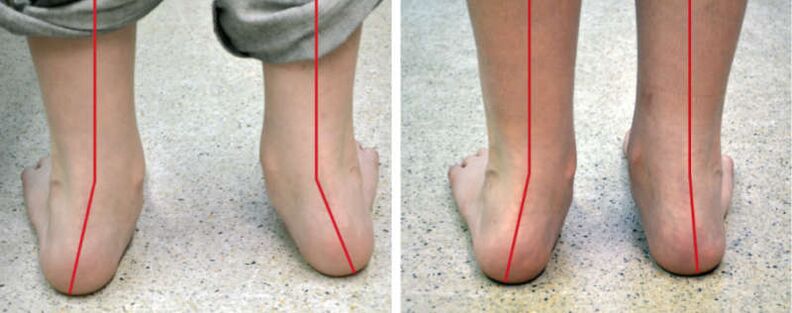 Turning legs outward