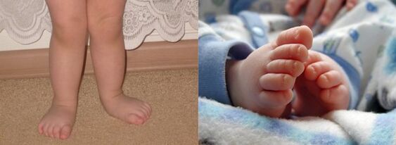 Fallen deformation of feet