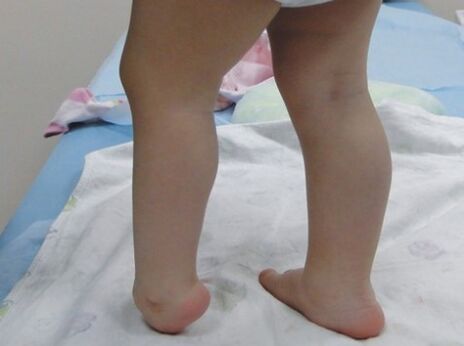 The first symptom of foot tilt deformation