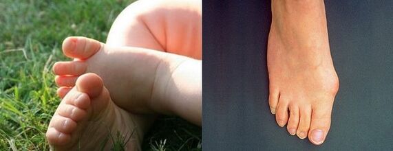 The outer deformation of the first finger of the foot