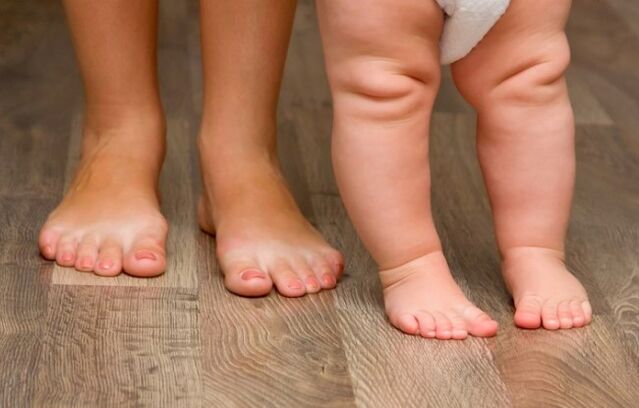 Deformation of children's feet