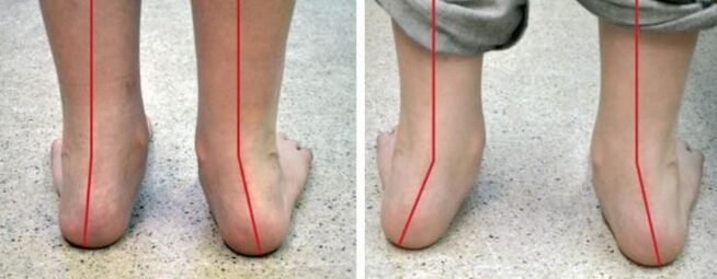 Turning feet out