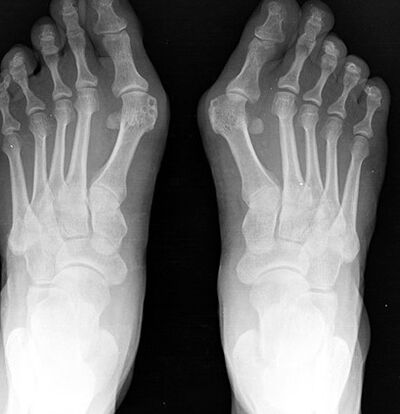 X-foot ray