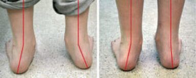 Curvature of the valgus